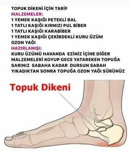 Topuk Dikenini Ne Yok Eder