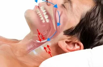 Horlama Tedavisi nasıl uygulanır? Horlamaya çare var mı?