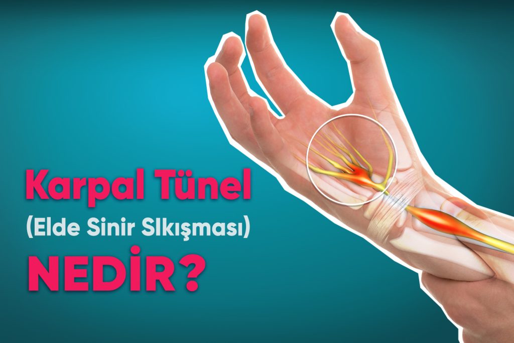 Karpal Tünel Hastalığı Nasıl İyileşir