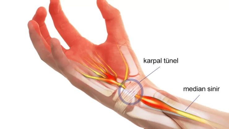 Karpal Tünel Sendromu Tedavisi nasıl iyileşir?