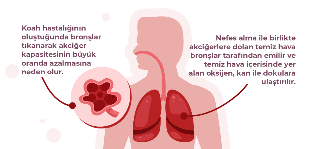 Koah Hastalığı Nasıl Düzelir?