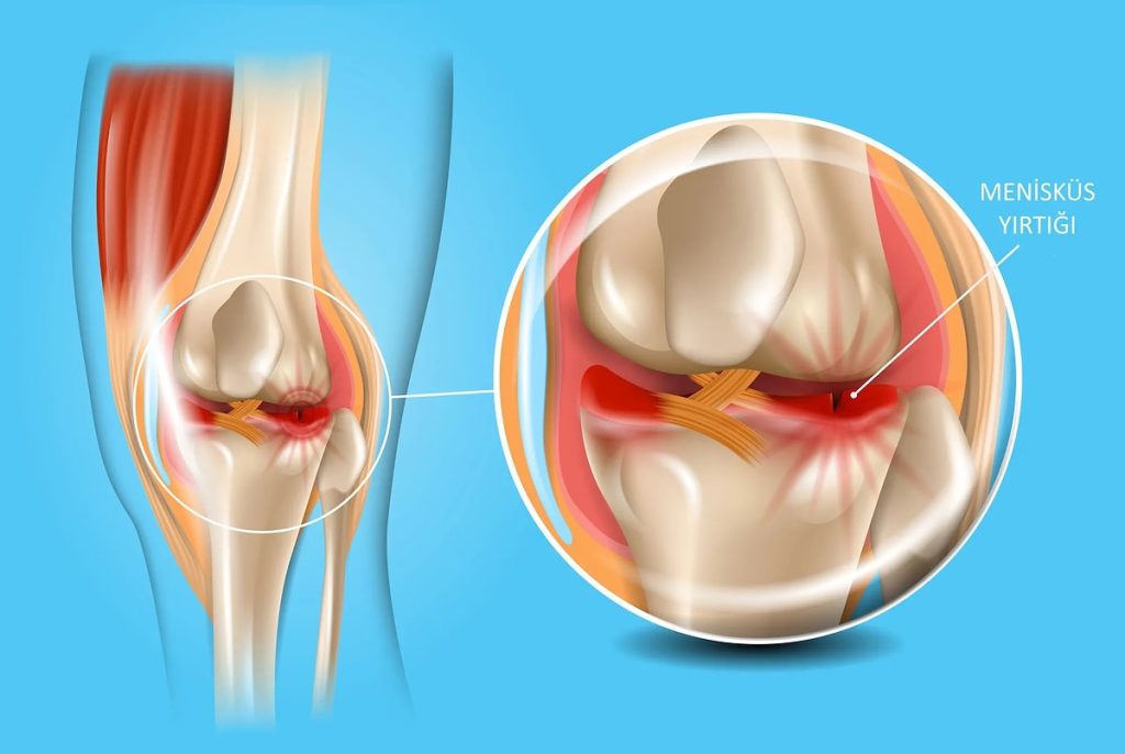 Menisküs Yırtığı Olan Kişi Ne Yapmalı