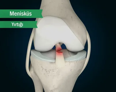 Menisküs Yırtığı Tedavisi Ne Kadar Sürer?