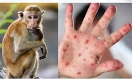 Maymun Çiçeği Hastalığı❗Virüs belirtileri nelerdir❓