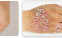 Kesin Sedef Hastalığı Tedavisi İçin en iyi ilacı nedir❓